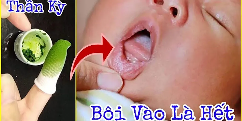 Cách trị nấm lưỡi cho trẻ sơ sinh