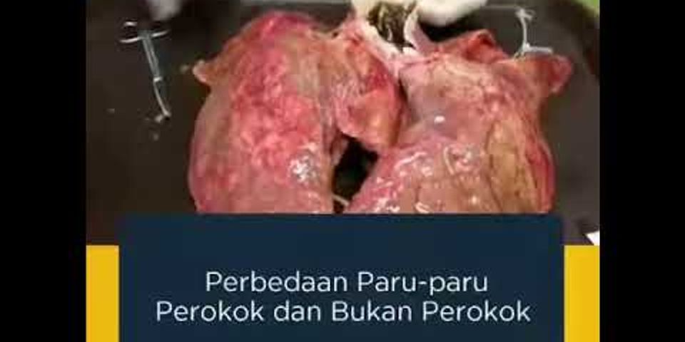 Perbedaan Kondisi Paru-paru Perokok Dan Bukan Perokok Brainly