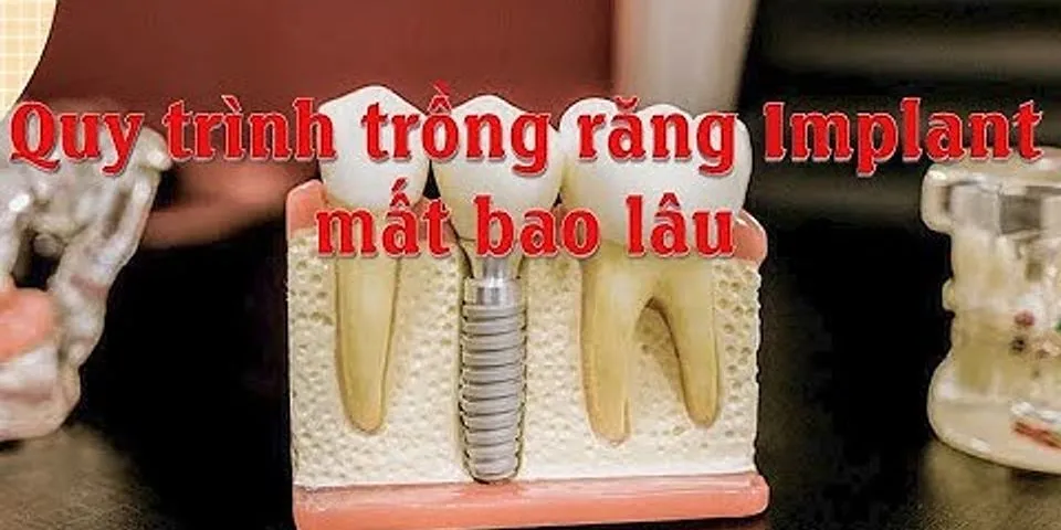 Quy trình trồng răng Implant mất bao lâu